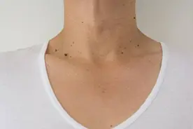 脖子上长小肉疙瘩，别不当回事，这或是这些疾病的征兆！图片