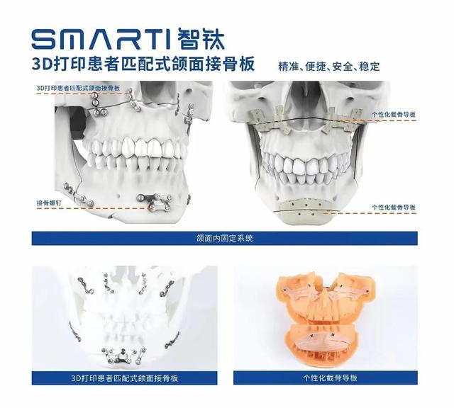 “导航手术”“3D打印颌面接骨板”……这批医学科技创新成果落地