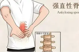 了解强直性脊柱炎，远离病痛拥抱健康图片