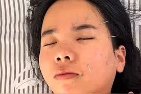 25岁女子午休吹风扇醒来后发现面瘫，医生：或与冷空气的刺激、自身免疫力下降有关图片