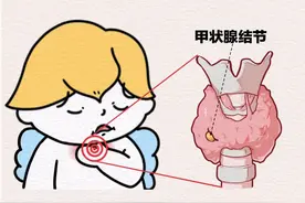 甲状腺结节会癌变吗？松山医院：别担心！大部分是良性图片