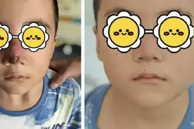 男子挤破身上痘痘住进ICU  一文告诉你哪些痘痘不能乱挤图片