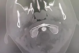 孩子睡觉打呼噜是得了“网红病”？竟是鼻子多长了一块肉……医生：拖久了可成“蛙鼻”！图片