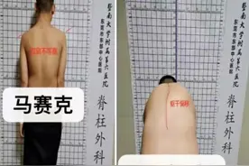 少年患罕见脊柱畸形远赴东莞，老乡医生对其成功实施矫正手术图片