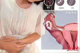 ​这个“巧克力”有点苦涩——卵巢巧克力囊肿图片