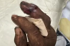 杭州男子手指被蛇咬，肿到发黑！外出踏青千万注意图片