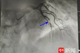 “回家吃点阿司匹林就好了”65岁男子次日胸痛被紧急送医！气温骤降，警惕心梗图片