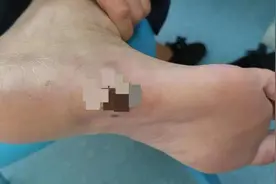 多年的足底黑痣竟化脓溃烂险危及性命，医生：系恶性黑色素瘤图片