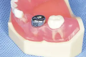 孩子乳牙龋坏为什么要做预成冠？植得口腔医生来科普图片