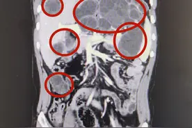 新疆小伙腹痛后查出20多个肿块，竟是感染这种寄生虫病图片