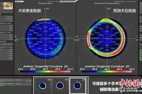 新方法可直观预测近视术后结果 助手术更可控图片