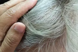 转发！白头发越长越多可能缺这3种营养图片
