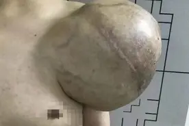 男子肩扛篮球大肿物两年！高难度手术“卸”下患者重负图片