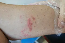 千万别拍打！拍打落在身上的小虫，杭州一男子竟被“泼酸”，痛到难以入睡图片