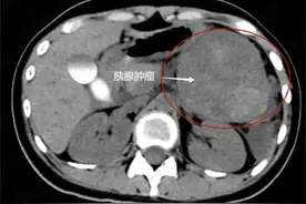 突发腹痛，大一女生被查出直径12厘米巨大胰腺肿瘤！专家提醒重视腹部健康检查，警惕上腹部疼痛不适、腹胀图片