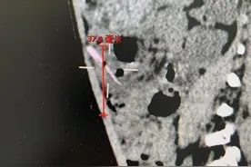 警惕！2岁女孩腹腔内有一根尖锐竹签！不少孩子都有这个习惯图片