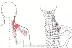 什么是肌筋膜炎？图片