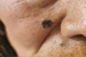 脸上出现“黑痣”，结果是癌！医生说1个月发现6例图片