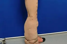 肿成“大象腿”！台州母女双双确诊！图片