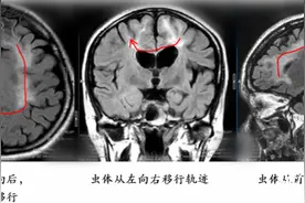 年轻女子大脑里揪出20厘米长活虫！病因和多年前饮食有关图片