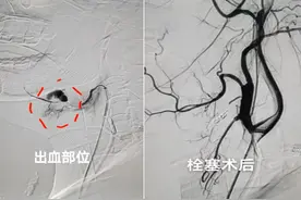 反复口腔溃疡别总说“上火”，小心是白塞病！图片