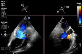 81岁老人心衰！不开胸，“小夹子”解决心脏“漏风”大问题图片