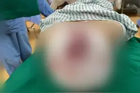 想想都痛！女子长发卷入机器，头皮被整片撕脱……广州医护及时出手→图片