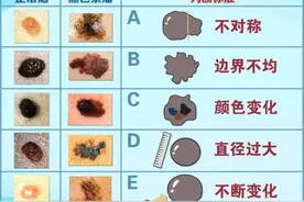 会癌变的“痣”，有5个特征图片