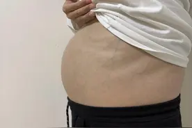 未婚未育，20岁女子肚子变大还出现“妊娠纹”，医生从她肚子里取出25斤“异物”图片