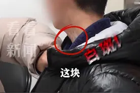 心酸!12岁男孩身上白斑越来越大 向医生吐露心声图片
