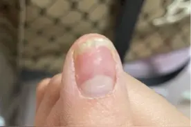 辽宁一女子花两百元美甲，花一万元治疗图片