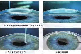 寒假摘镜总动员丨23秒完成近视矫正图片
