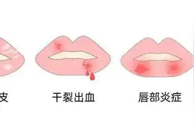 嘴唇干裂原来不是缺水，而是缺这个！图片