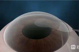 高考后“摘镜热”！四大近视手术深度PK，一篇看懂不迷茫图片