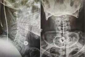 滨医附院神经外科应用短时程脊髓电刺激术破解微意识状态与上肢痉挛难题图片