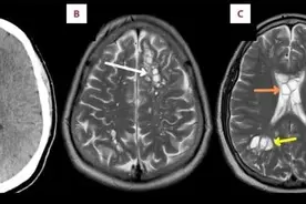 ​美国男子偏头痛加剧持续数月 竟是寄生虫在大脑产卵导致图片