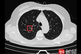 医院上新|江苏首例！气管镜机器人作“导航”实现实时成像，成功射频消融深部肺结节图片