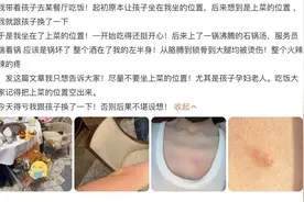 别再抹牙膏、酱油、白酒了！烫伤急救“五字诀”了解一下→图片