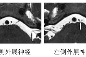 女子车祸致“斗鸡眼”，求医无门！上海医生用了种很新的技术成功治愈图片