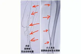 医生从女子左腿“掏出”三四十厘米血栓，只因她连续两个月吃了……图片