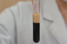 暴饮暴食致剧烈腹痛 重症患者抽出“牛奶血”视频封面