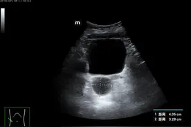 长沙一6岁女孩来月经，确诊假性性早熟，医生称一个月接诊4例相关患儿图片