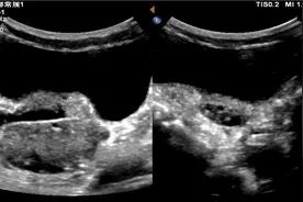 5岁女孩跳绳后剧烈腹痛，竟查出卵巢扭转720°！右侧卵巢被切除图片