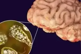 和玩水有关？5岁女孩被感染后持续昏迷！家长痛心疾首，上海医生紧急提醒图片