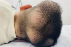 罕见人生｜5岁男童患“超级罕见病”，国内此前仅报道过1例图片
