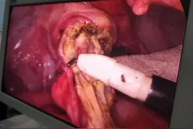 这个大腿根的“软疙瘩”差点要了命！他紧急手术捡回一条命图片