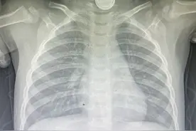 当心！玩具、画板、车钥匙……竟隐含儿童误吞新风险图片