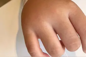 近期多发！不少人中招！福州刘女士：痒到崩溃！图片