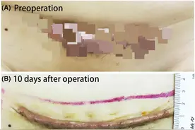 36岁宝妈剖宫产三年后，腹部瘢痕还在长大图片