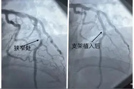 别不当回事！男子牙疼数日，没想到是心肌梗死图片
